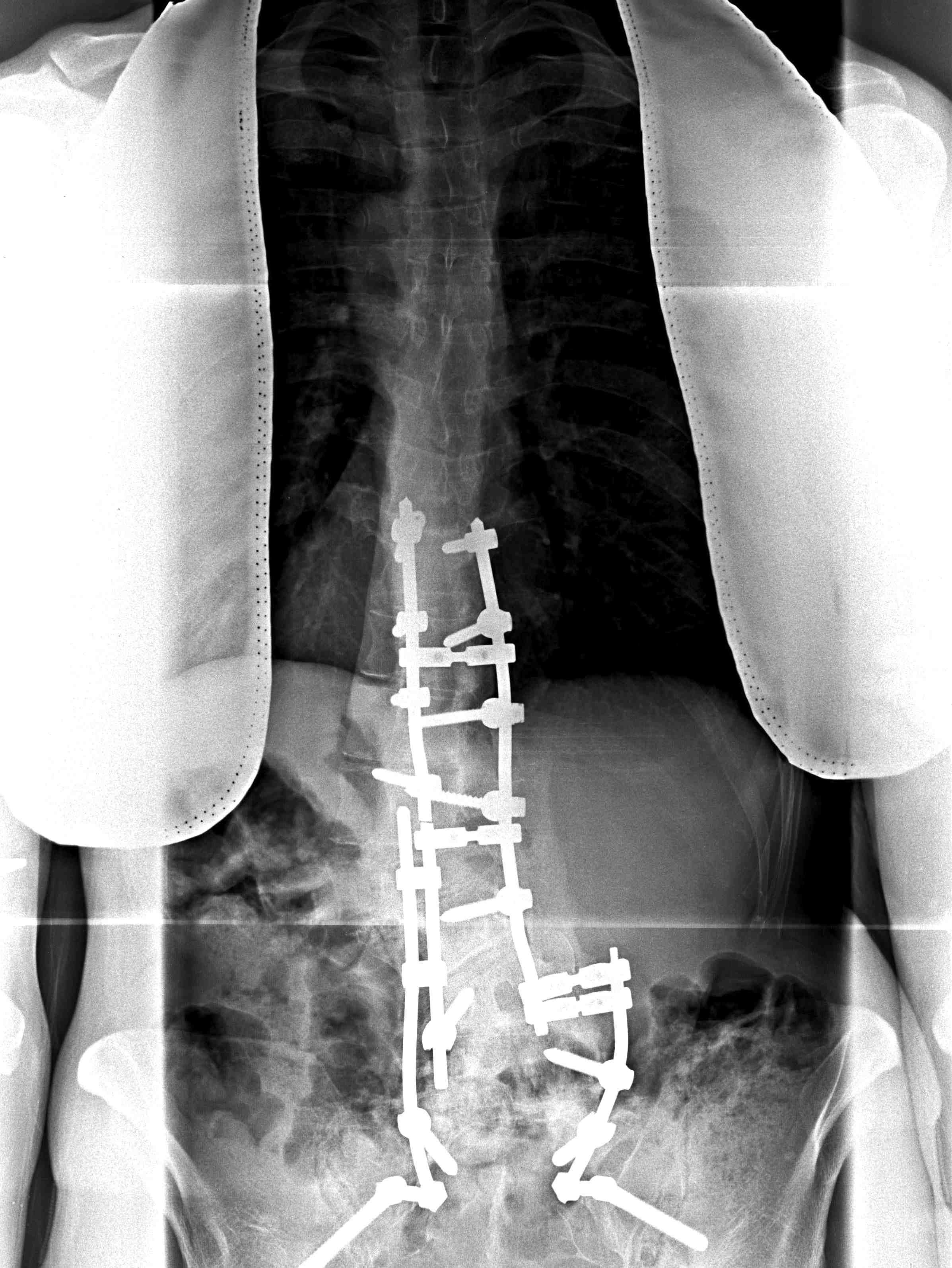 Scoliosis Lumbar Curve Fusion